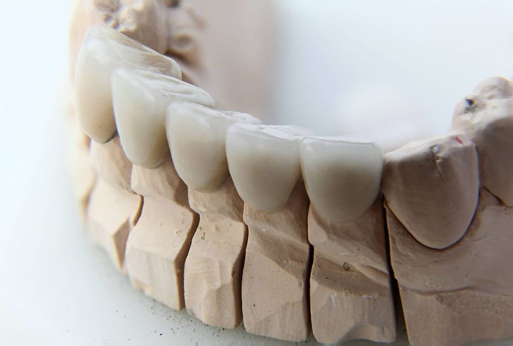Dental crowns near me